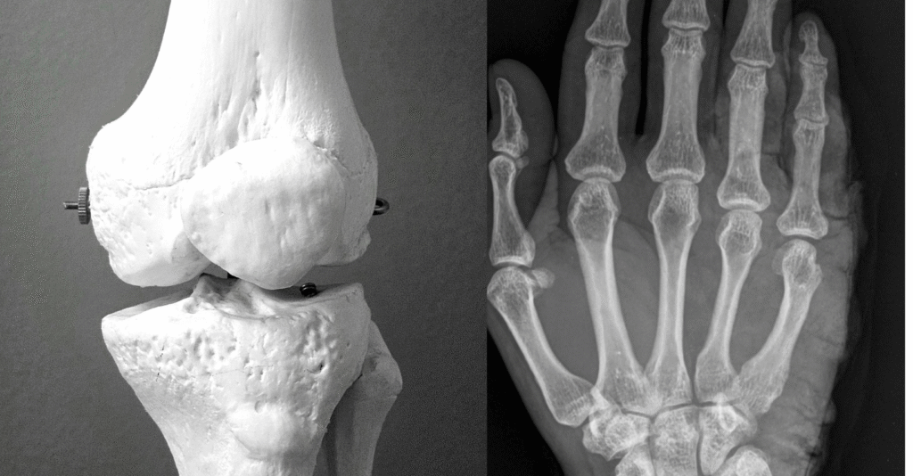 साइएटिका पेन (Sciatica Pain) – कारण, लक्षण, उपचार और होमियोपैथिक समाधान Lower back se leg tak sharp pain
✔️ Pair me burning sensation ya electric shock jaisa dard
✔️ Pair ya toes me numbness (सुन्नपन)
✔️ Leg me weakness ya heaviness feeling
✔️ Long sitting par pain badh jana
✔️ Jhukne, uthne ya chalne par pain increase hona